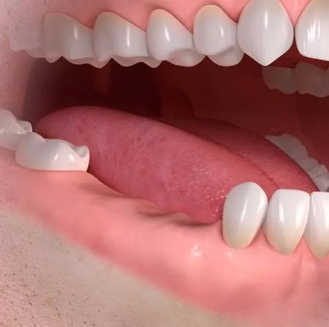 mancanza di piu denti